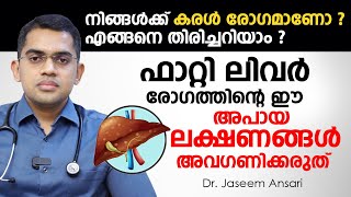 ഫാറ്റി ലിവർ ഈ അപായ ലക്ഷണങ്ങൾ അവഗണിക്കരുത്  Fatty Liver Malayalam Video  Dr Jaseem Ansari [upl. by Rufena92]