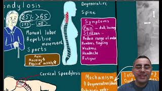 Spondylosis Symptoms causes disease course and treatment [upl. by Adrahs448]