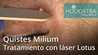 Quistes Milium  Tratamiento con láser Lotus 20219 [upl. by Yert794]