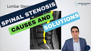 Lumbar Spinal Stenosis  What is the cause and how will I get better [upl. by Hachman]