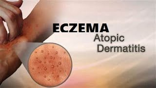 What is Eczema A Type of skin condition I Atopic Dermatitis I Allergic eczema I Neurodermatitis [upl. by Aitsirt545]