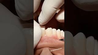 Class IV composite restoration dentist satisfying [upl. by Sadnalor]