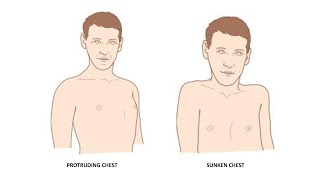 CAUSES OF PROTRUDING CHEST PECTUS CARINATUM PIGEON CHEST SUNKEN CHEST IN TCM [upl. by Hadias]