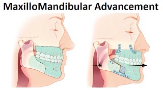 Surgical Treatment of Retruded Jaws MaxilloMandibular Advancement Surgery by Dr Mike Mew [upl. by Foah]