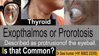 Exopthalmos or Prorotosis  Described as protrusion of the eyeball [upl. by Shandeigh]