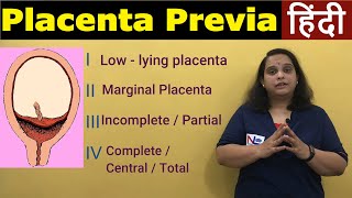 Placenta Previa in Hindi  APH Antepartum HemorrhageTypes Risk factors Symptoms  Nursing Lecture [upl. by Adlei306]