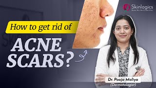 How to get rid of Acne Scars  MNRF treatment for Acne Scars  Best Skin Specialist in Noida [upl. by Seugirdor]