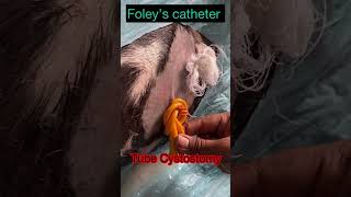 Tube Cystostomy l Foley’s catheter l Dr Umar Khan [upl. by Jaquenetta228]