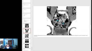 Primary Mesenteric Adenitis Imaging [upl. by Ycram566]