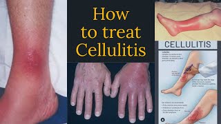 iv antibiotics for cellulitis [upl. by Allesiram]