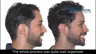 Jaw surgery Case  102 Jonathan  Sleep Apnea Lack of mandibular projection [upl. by Euqinommod]