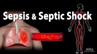 Sepsis and Septic Shock Animation [upl. by Anelim]