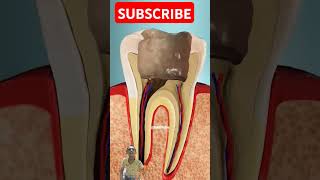 Root Canal Treatment 3D Animation shorts ytshorts dentist rootcanaltreatment smile doctor [upl. by Maletta]