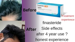 Finasteride side effects after 4 years use and results EXPERIENCE Hair treatment part 5 [upl. by Utham]