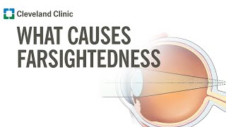 What Causes Farsightedness [upl. by Aydni625]