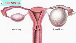 Ovarian Cyst Symptoms and Exactly What Can Be Done [upl. by Cleo358]