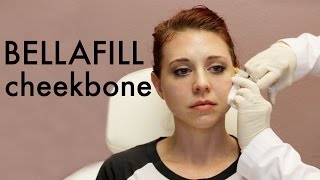 Bellafill Injection for Cheekbone Lift and Temple [upl. by Arundell]