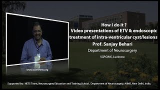 How i do it  Video presentations of ETV and endoscopic treatment of intraventricular cystlesions [upl. by Rooke]