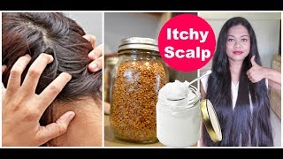 How To Cure Dry Scalp Dandruff And Psoriasis With DrMike [upl. by Adnahsal]