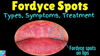 Fordyce Spots Symptoms Causes amp Treatment  Fordyce Spots on lips  Fordyce Granules [upl. by Charlene299]