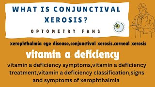 vitamin a deficiency  xerophthalmia eye disease  conjunctival xerosis  corneal xerosis [upl. by Dane]