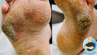 EXTRA THICK HARD SKIN REMOVAL TREATMENT CRAZY BIG CALLUS [upl. by Imoen156]