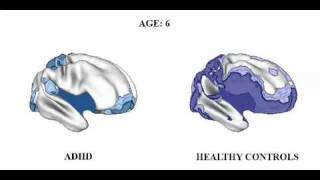 Brain matures a Few Years Late in ADHD but follows Normal pattern [upl. by Etteniuqna937]