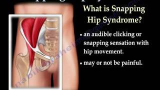 Snapping Hip Syndrome  Everything You Need To Know  Dr Nabil Ebraheim [upl. by Erdei]