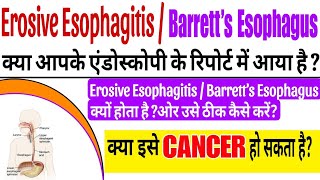 Erosive Esophagitis amp Barretts Esophagus क्या होता है [upl. by Sevy]