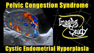 Pelvic Congestion Syndrome amp Endometrial Cystic Hyperplasia  Ultrasound  Doppler  Case 90 [upl. by Ecyoj]