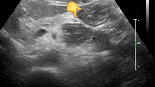 Diagnostic dilemma Pancreatic Lesion Jejunal Loop Mimicking Cancer on Ultrasound – CT Clarifies [upl. by Marni]