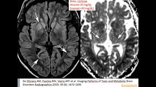 56 Hypoglycemic encephalopathy low glucose thalamic sparing insulin shock therapy [upl. by Borroff]