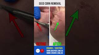 Seed corn removal [upl. by Ainivad]