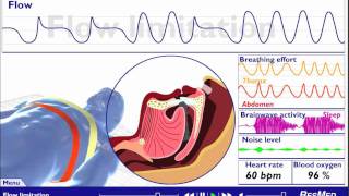 Understanding Sleep Disordered Breathing [upl. by Rojas]