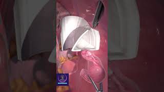 Laparoscopic Tissue Removal shorts medicalsurgery [upl. by Dorina]