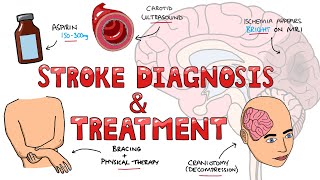 Stroke Diagnosis and Treatment  Acute and Long Term Treatment of Ischemic and Hemorrhagic Stroke [upl. by Aicyla]