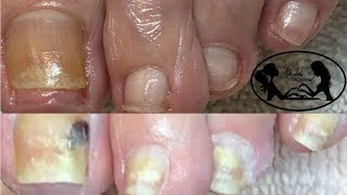 Pedicure Tutorial How to Safely Cut Toenails Fungus Cure Update✔️ [upl. by Aretina]