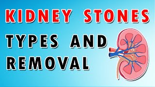 Kidney Stones  Types Diet and Removal Treatment [upl. by Edithe751]