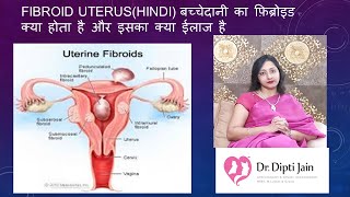 FIBROID UTERUSHINDI बच्चेदानी का फ़िब्रोइड क्या होता है और इसका क्या ईलाज है [upl. by Aihn341]