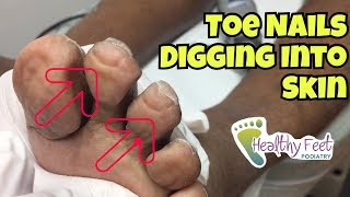 Nails Curling Into Toes  Nail Trimming for Diabetic Ingrown Nails at the Ends of the Toe [upl. by Aerdnaek]