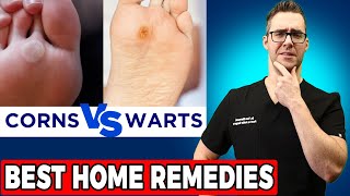 Plantar Warts vs Corns vs Calluses TOP 20 BEST Home Remedies [upl. by Elaynad]