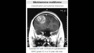 Glioblastoma Multiforme grade IV astrocytoma  Most Common Primary Brain Tumor [upl. by Edward]