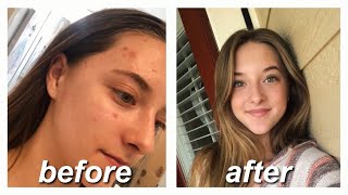 ACCUTANE FOR MILD ACNE  my story amp monthly updates [upl. by Domenic831]