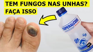 ADEUS FUNGOS NAS UNHAS Esta é a Melhor Solução Para ELIMINAR Fungos nas Unhas [upl. by Tobiah870]