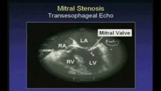 Rheumatic Mitral Stenosis  Transesophageal Echocardiogram [upl. by Demb]