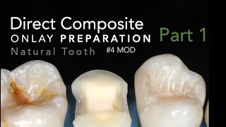 Direct Composite Onlay Part 1 Preparation  4 MOD Natural Tooth [upl. by Takara46]