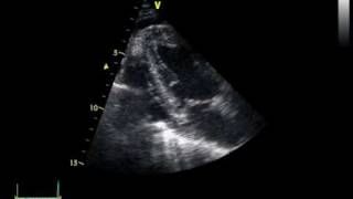 CHRONIC PERICARDITIS with thickening of the pericardium [upl. by Prowel]