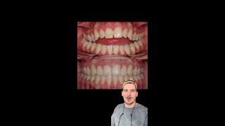 Fixing an Open Bite with Braces  StepbyStep Protocol [upl. by Elah]