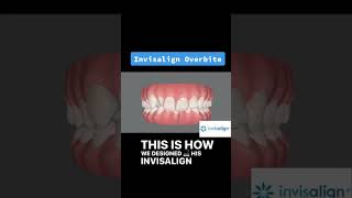 invisalign overbite [upl. by Berrie602]