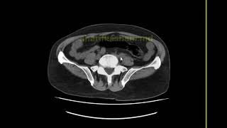 Idiopathic retroperitoneal fibrosis [upl. by Michail]